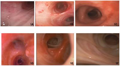 Bronchoscopy and molecular diagnostic techniques to identify superimposed infections in COVID-19-associated ARDS: a case series from Ecuador during the second wave